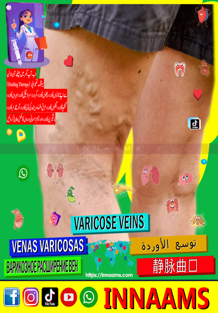 innaams Varicose Viens 001